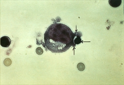 NK細胞(リンパ球)