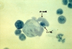 NK細胞(リンパ球)